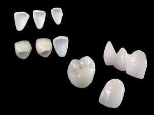 強くて美しい被せ物